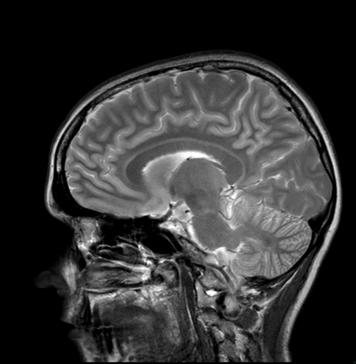 Neuroradiology brain and spine imaging
